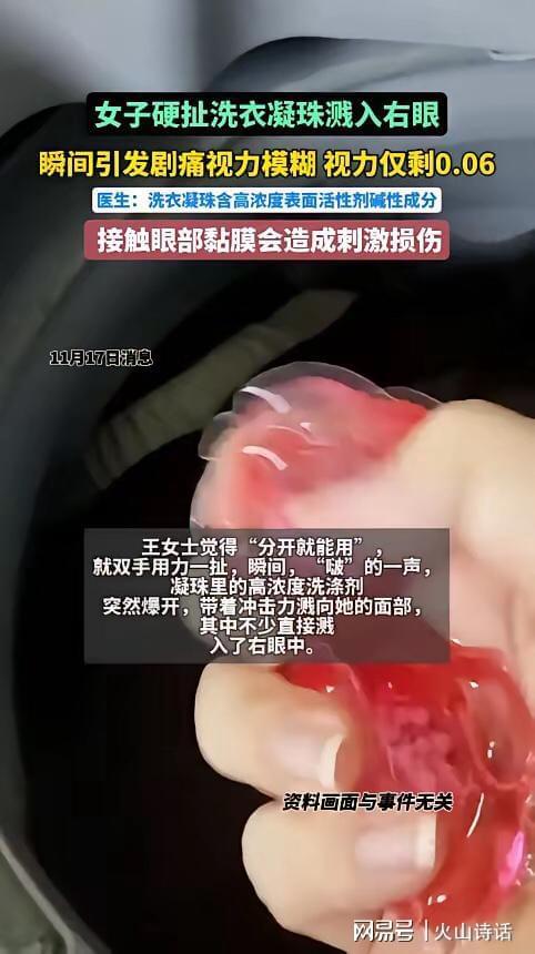 ”杭州一女子撕扯凝珠发生意外致眼睛失明PG麻将胡了模拟器恐怖！洗衣引发“爆炸